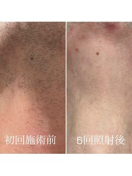 バルダー 原宿 神宮前(BALDER.)/メンズ(髭)脱毛