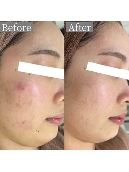 ホワイトアクア 鳳店(WHITE AQUA)/ハーブピーリング/毛穴/大阪/鳳