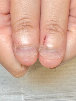 グラシュータン(gracieux temps)の写真/短期間で変化を実感◎爪の悩みは人それぞれ…自爪の健康を第一に考えた丁寧な施術&ケアをご提供★