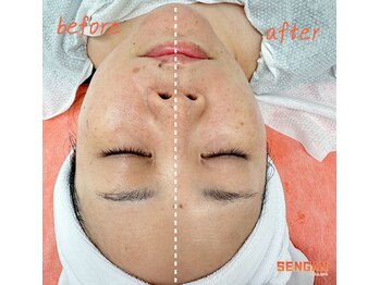 センガン(SENGAN)/アゴのラインもすっきり!