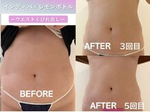 ラディアント(Radiant)/インディバ×レモンボトル