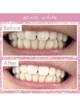 エクシアホワイトニング 天王寺店/ホワイトニングビフォーアフター