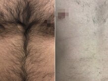脱毛専門サロン エリクサー(Elixir)/Before After