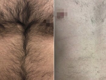 脱毛専門サロン エリクサー(Elixir)/Before After