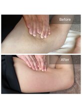 アピアランスビューティー 浦和店/太ももの皮下脂肪撃退！