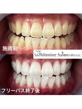 ホワイトニングサロン 京都烏丸店/ホワイトニング施術例