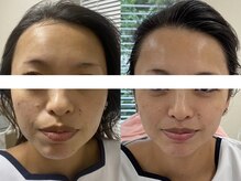 サクラ 伊勢原店(SAKURA)/フェイシャルエステ以上の効果