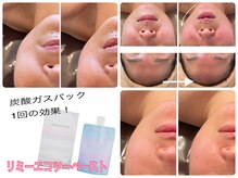 ラ ルミエール(La Lumiere)/炭酸ガスパックがオススメ！