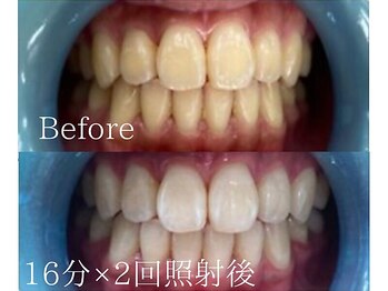 ホワイトニングカフェ 宜野湾店(WhiteningCafe)/◎歯のホワイトニング施術写真◎