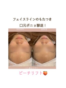 エスポワ/最新機器◆ピーチリフト