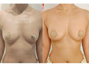 エミュボディ 青山本店(emu body)/バストアップ写真　乳房リリース