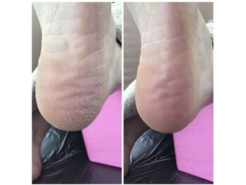 事例【ドイツ式フットケア】