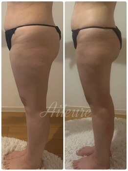 エルール トータルビューティ(Aileure total beauty)/インディバ×アミノ酸