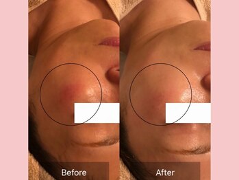 アメリイ 百合ヶ丘 新百合ヶ丘(Amerii)/シミ/エイジングケア/美白