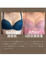 エミニナル(EMININAL)/【バストケア】ビフォーアフター