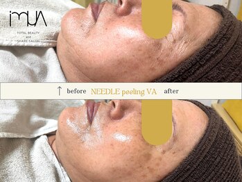 イムア(imua)/目覚める肌NピーリングVA