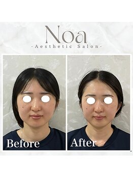 ノア 新宿(Noa)/小顔矯正+ハーブピーリング 1回
