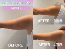 ラディアント(Radiant)/インディバ×レモンボトル