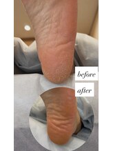 フットミー(foot mii)/１回目Before・After