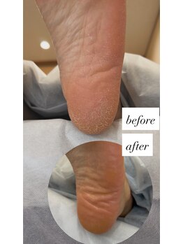 フットミー(foot mii)/１回目Before・After