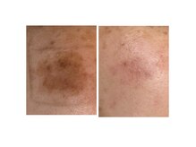 ノーファンデの樹 健康の丘の雰囲気（最新のシミケアで気になるシミを徹底ケア!【フラットラッシュ】）