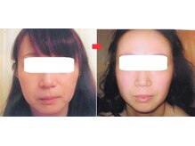 サロンドエステケイワイ(de KY)/フェイシャル☆小顔・タルミ改善