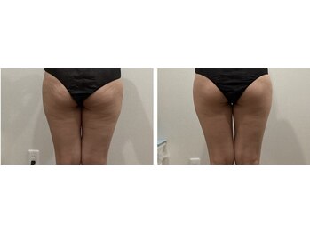 ラナビューティリゾート(Lana Beauty resort)/エステ担当★30代1回でこの変化