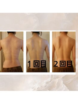 プルーム 久留米店(plume)/ハーブピーリング／背中