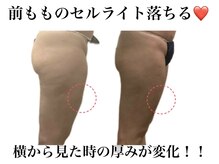 痩身革命 大宮店/痩身下半身スライドカッピング♪