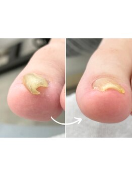 爪の悩みを解消できる（ケア含む）