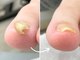 フィーカ 松戸駅前店(FIKA)の写真/【爪が食い込む巻き爪に】ただカットするだけじゃない！爪のプロが専用器具を使い根本からケア。