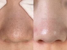 ベルエドゥース(Belle et Douce)/毛穴の黒ずみ症例