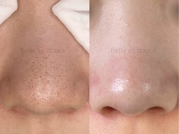 ベルエドゥース(Belle et Douce)/毛穴の黒ずみ症例