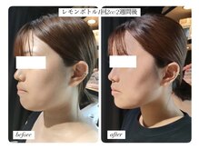 ディアビム(DiAViM)/◆脂肪分解美容液レモンボトル◆