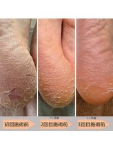 マオヌー(MAONU)/韓国式足裏角質ケア　症例写真