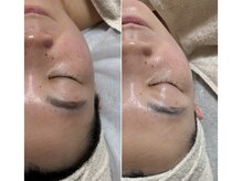 フェイスワックス×クリスティーナトリートメントで根本肌質改善