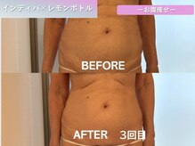 ラディアント(Radiant)/インディバ×レモンボトル