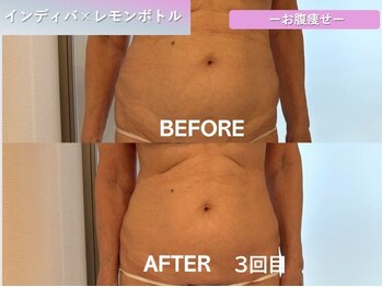 ラディアント(Radiant)/インディバ×レモンボトル