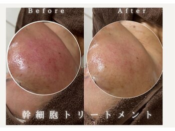 ヴィヴィアン 熊谷店(Vivian)/【幹細胞トリートメント】