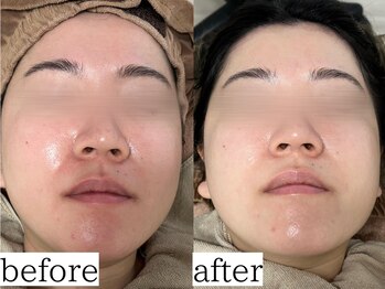 アンドナップ(nap)/乾燥肌、敏感肌でも大丈夫