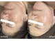 サロン ド ユイ(salon de yui)の写真/【熊本に2台の希少機械】40代からのシミ・シワケア！ハイピール導入で若々しいノーファンデツヤ美肌へ♪
