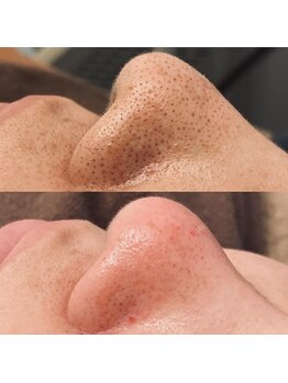 ベル リュンヌ(Belle lune)/毛穴エクストラクション