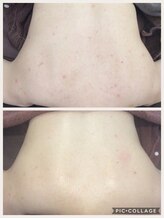 アネル 美里店(anel)/背中をきれいにしましょう！