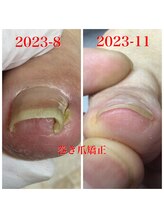 プラスキュア 用賀店(+CURE)/巻き爪矯正【1爪】＋爪切￥8800