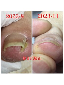 プラスキュア 用賀店(+CURE)/巻き爪矯正【1爪】+爪切¥8800