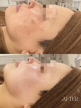 ミリ(MiLi)/陶器トリートメント