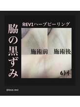 マヤヒメ(mayahime)/脇の黒ずみ