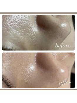 ヒラキヒミ。/毛穴洗浄エステ+上半身