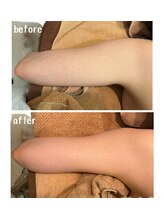 ラディアント(Radiant)/インディバ×レモンボトル