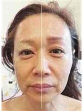 キオーナ 富雄店/πセラピー小顔矯正術の効果